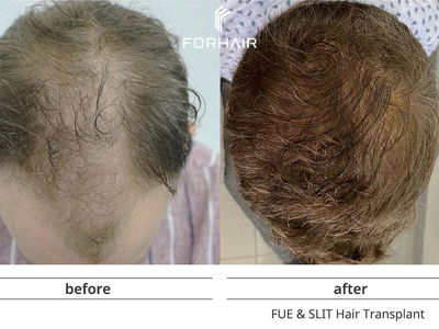 FORHAIR Hair Transplant Korea, Seoul, South Korea
