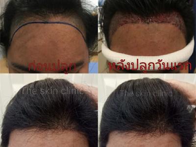 Dr. Narupaves's Hair Transplant Center, Bangkok, Thailand