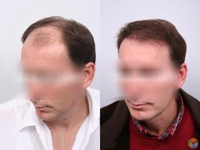 CARE Hair Transplant Center of Istanbul, Istanbul, Turkey
