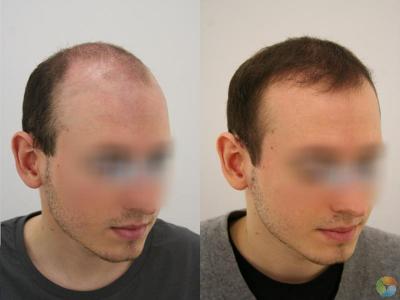 CARE Hair Transplant Center of Istanbul, Istanbul, Turkey