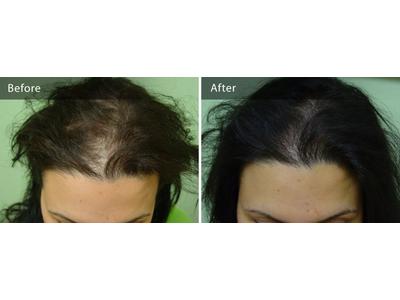 Dermatologist Dr. Karalexis - Expert in FUE Hair Transplantation - DermaHair Clinic , Athens, Greece