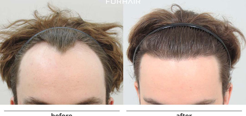 FORHAIR Hair Transplant Korea, Seoul, South Korea | Get FREE Quote