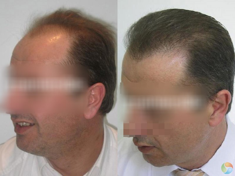 Пересадка волос в стамбуле. Клиника по пересадке волос до после. Клиника пересадки волос в Турции. Алания трансплантация волос.