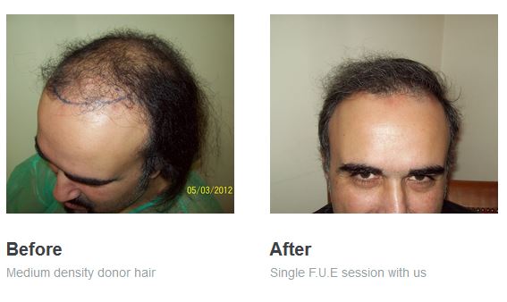 High Density Hair Transplant Clinic - Hair Transplant Clinics | Find Hair  Loss Surgeons in Our Exclusive Hair Restoration Network Worldwide